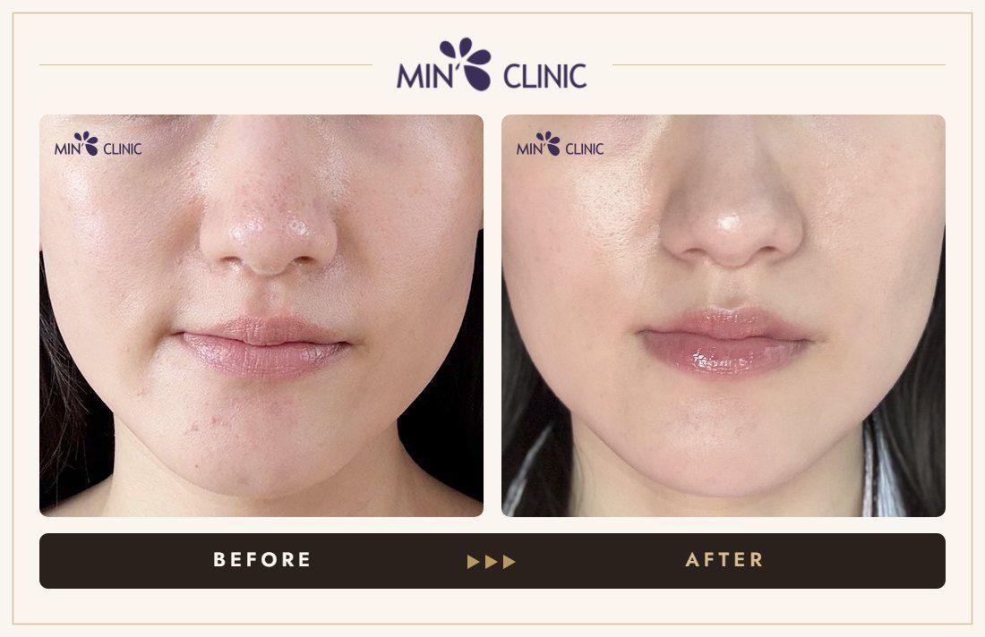 Collagen stimulator before and after – MIN Clinic Gangnam, Seoul