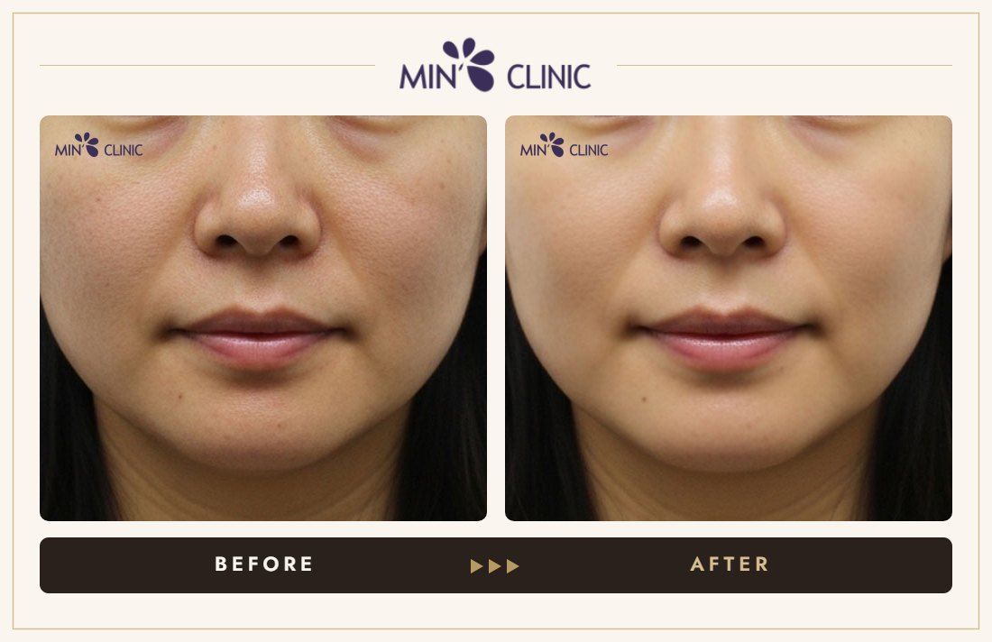 Olidia Myo before and after, case 4 – MIN Clinic Seoul