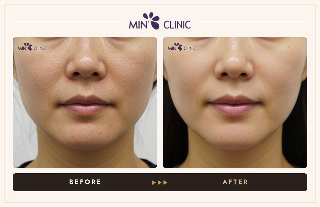 Olidia Myo before and after, case 3 – MIN Clinic Seoul