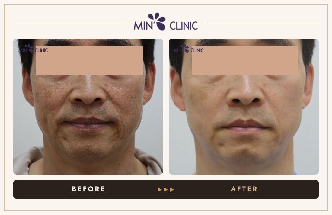 Olidia Myo before and after, case 2 – MIN Clinic Seoul