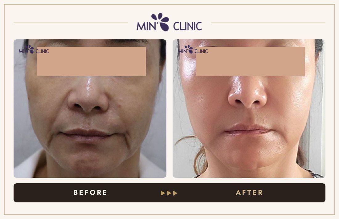 Olidia Myo before and after, case 1 – MIN Clinic Seoul