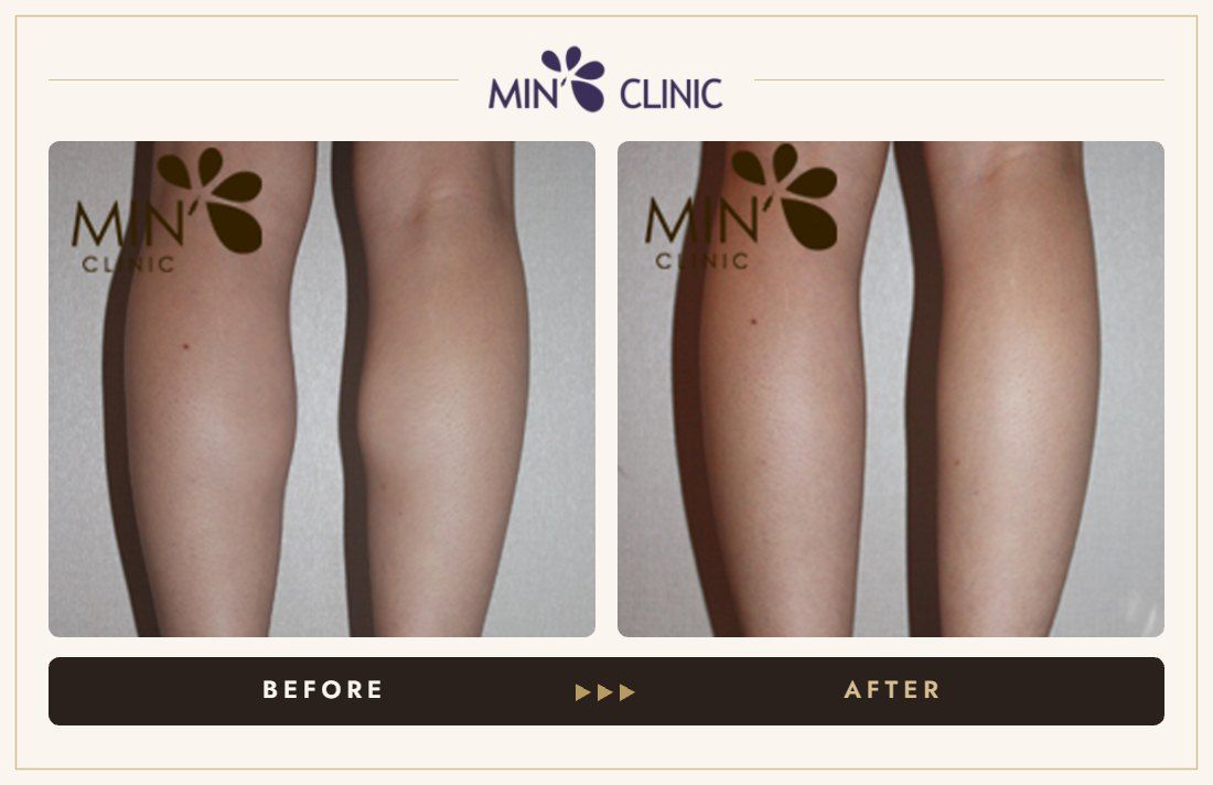 Double Skinny before and after, case 3 – MIN Clinic Seoul