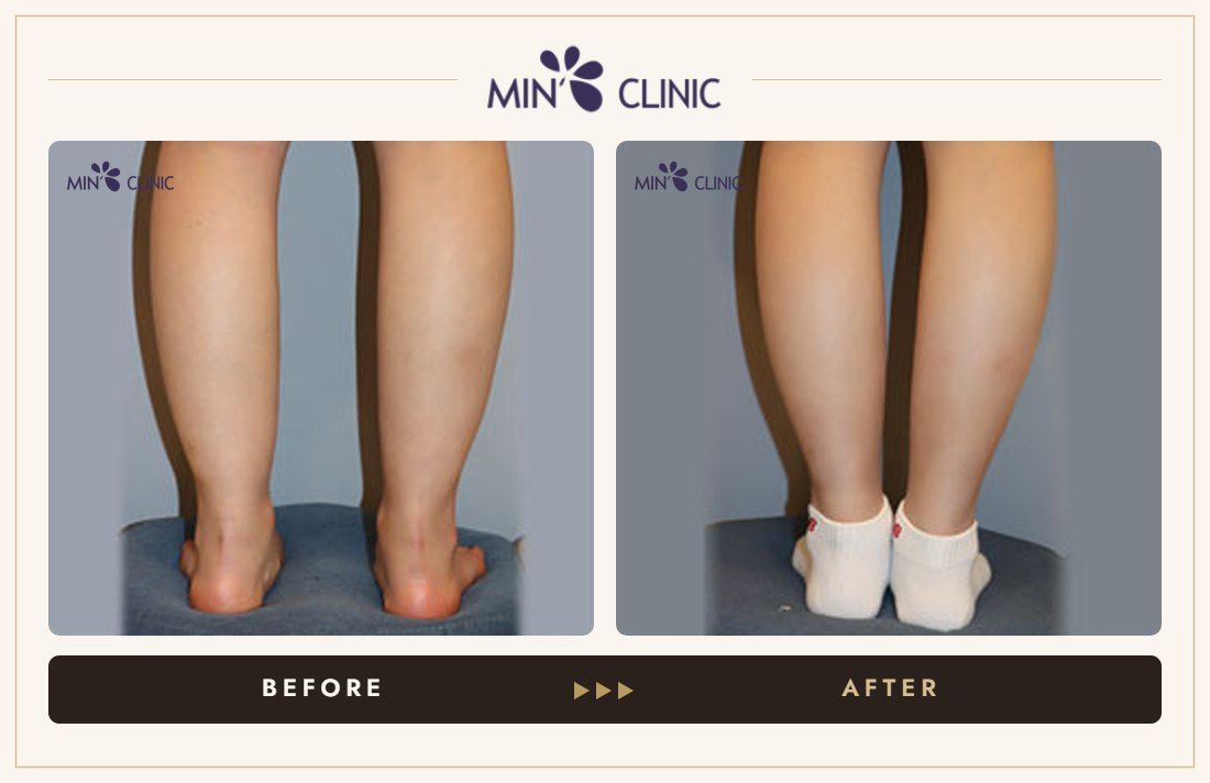 Double Skinny before and after, case 4 – MIN Clinic Seoul