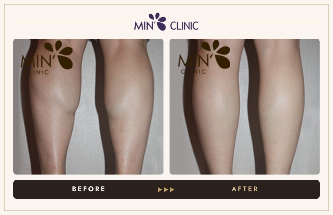 Double Skinny before and after, case 6 – MIN Clinic Seoul