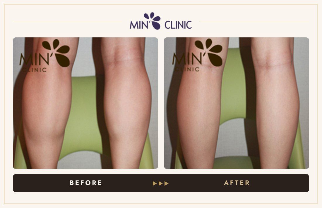 Double Skinny before and after, case 7 – MIN Clinic Seoul