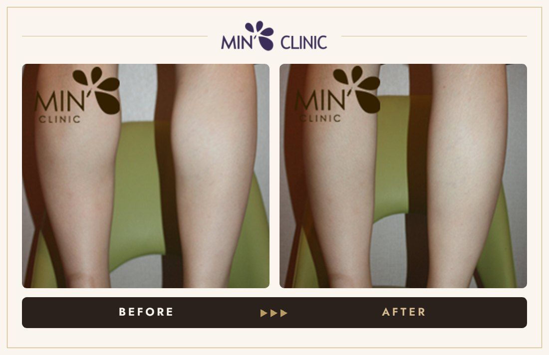 Double Skinny before and after, case 8 – MIN Clinic Seoul