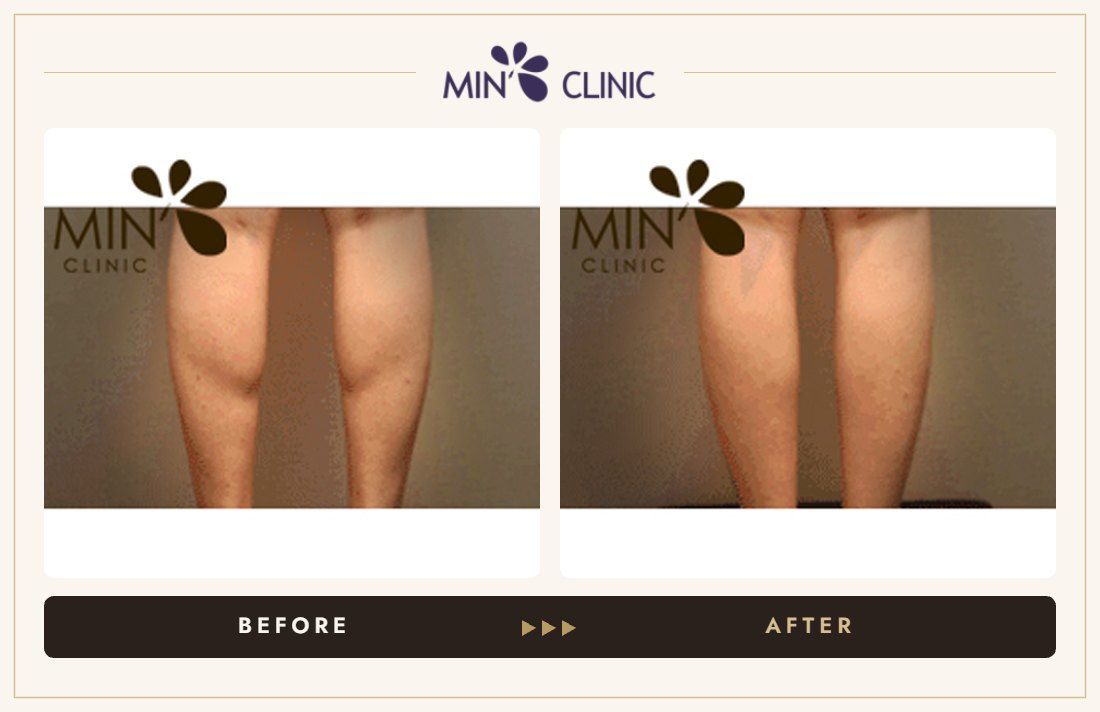 Double Skinny before and after, case 9 – MIN Clinic Seoul