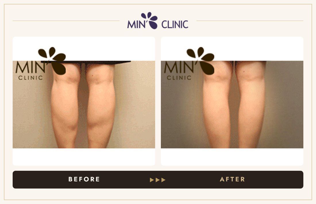 Double Skinny before and after, case 10 – MIN Clinic Seoul