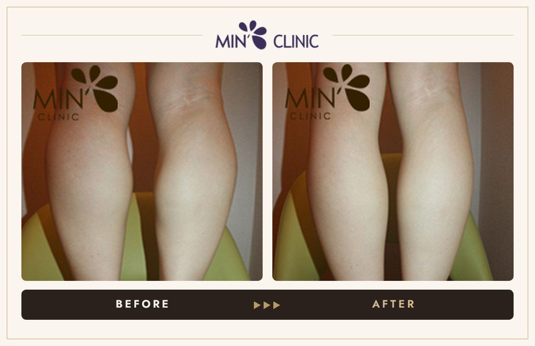 Double Skinny before and after, case 11 – MIN Clinic Seoul
