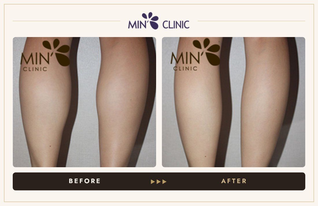 Double Skinny before and after, case 12 – MIN Clinic Seoul