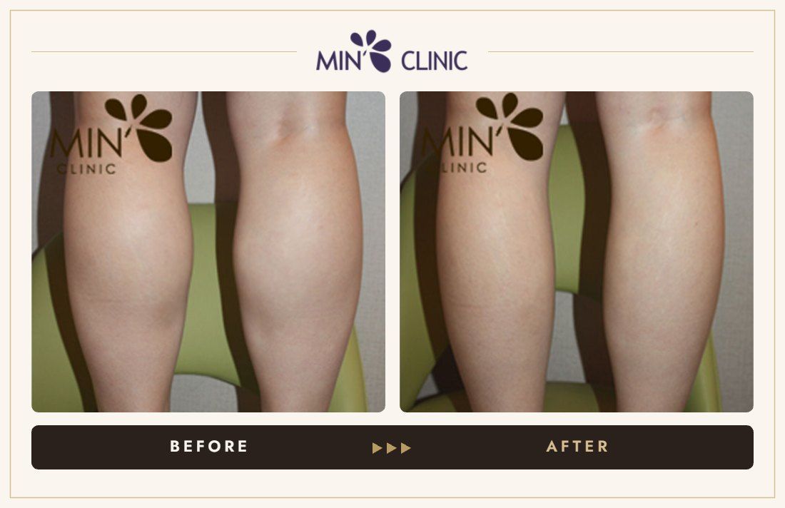 Double Skinny injection before and after, case 1 – MIN Clinic Seoul