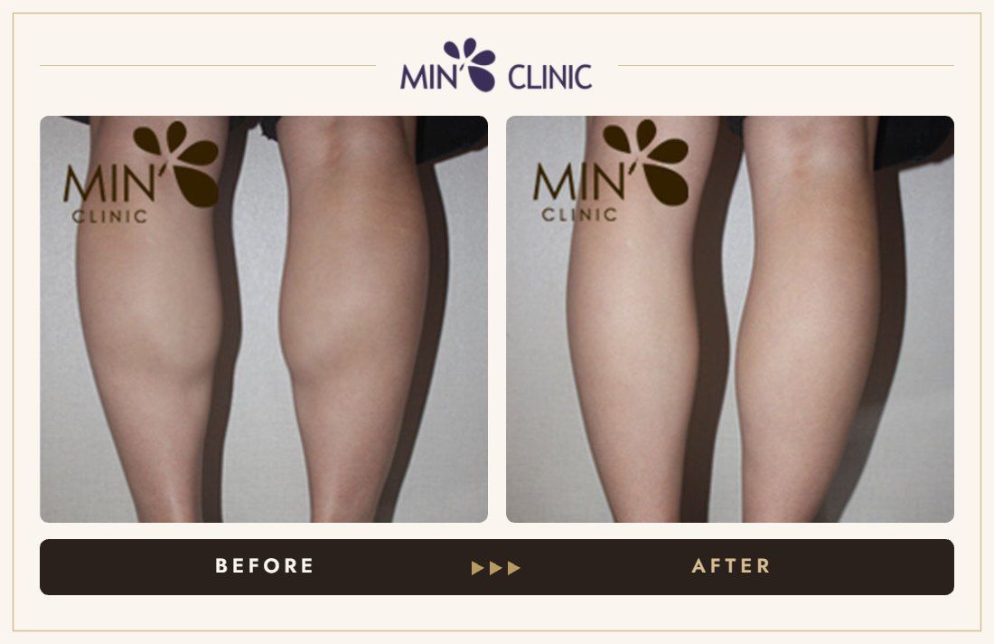 Double Skinny before and after, case 13 – MIN Clinic Seoul