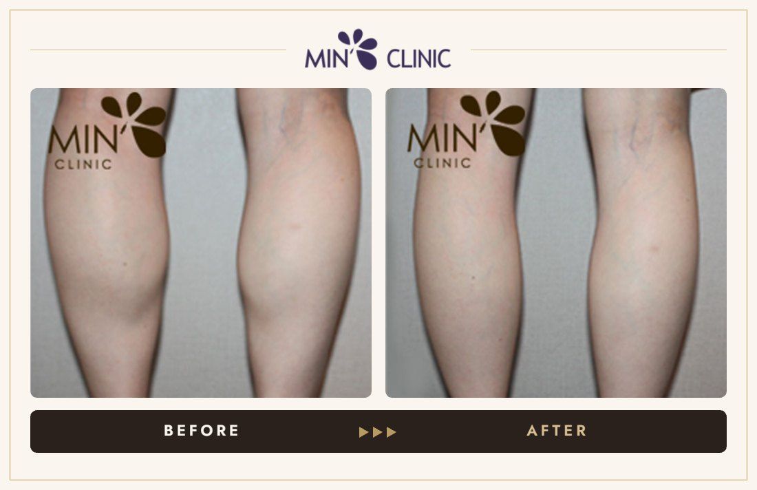 Double Skinny before and after, case 14 – MIN Clinic Seoul