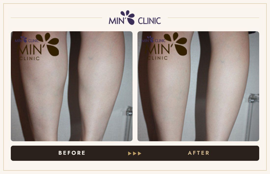 Double Skinny before and after, case 15 – MIN Clinic Seoul