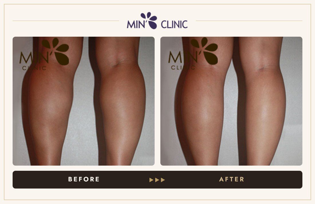Double Skinny before and after, case 16 – MIN Clinic Seoul