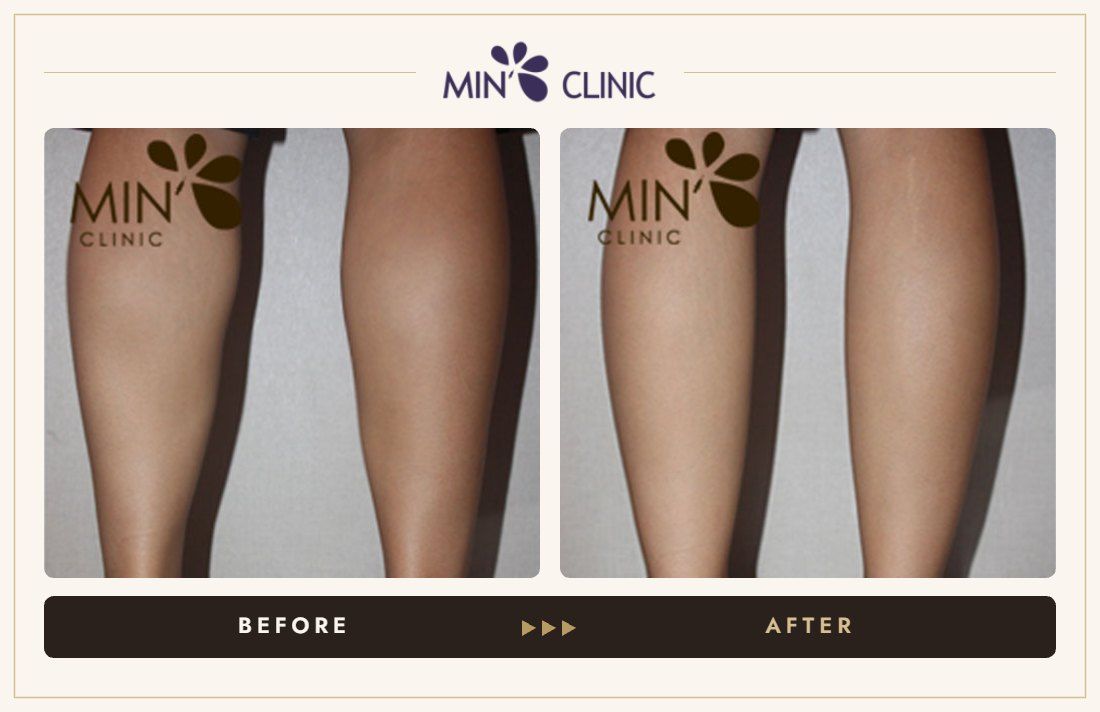 Double Skinny before and after, case 17 – MIN Clinic Seoul