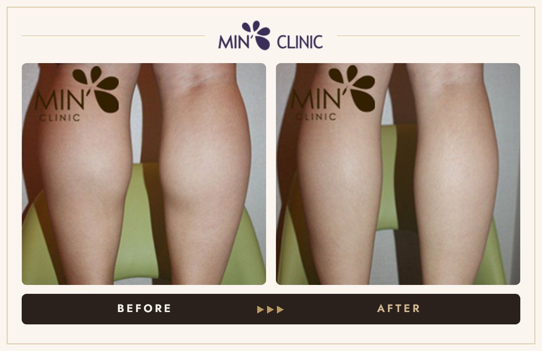 Double Skinny before and after, case 18 – MIN Clinic Seoul
