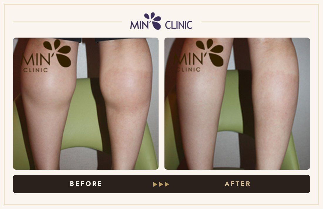 Double Skinny before and after, case 19 – MIN Clinic Seoul