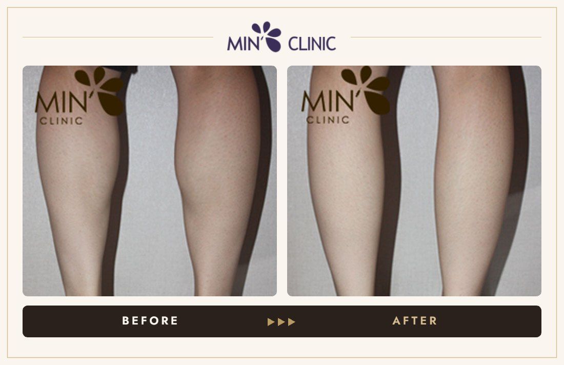 Double Skinny before and after, case 20 – MIN Clinic Seoul
