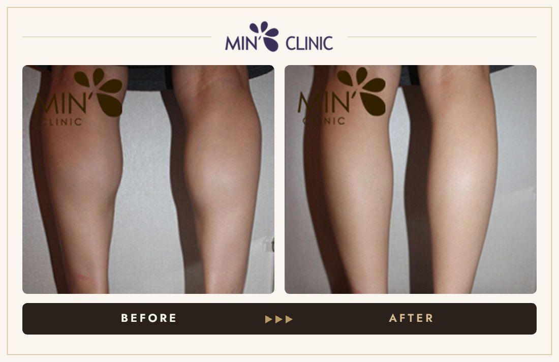 Double Skinny before and after, case 21 – MIN Clinic Seoul
