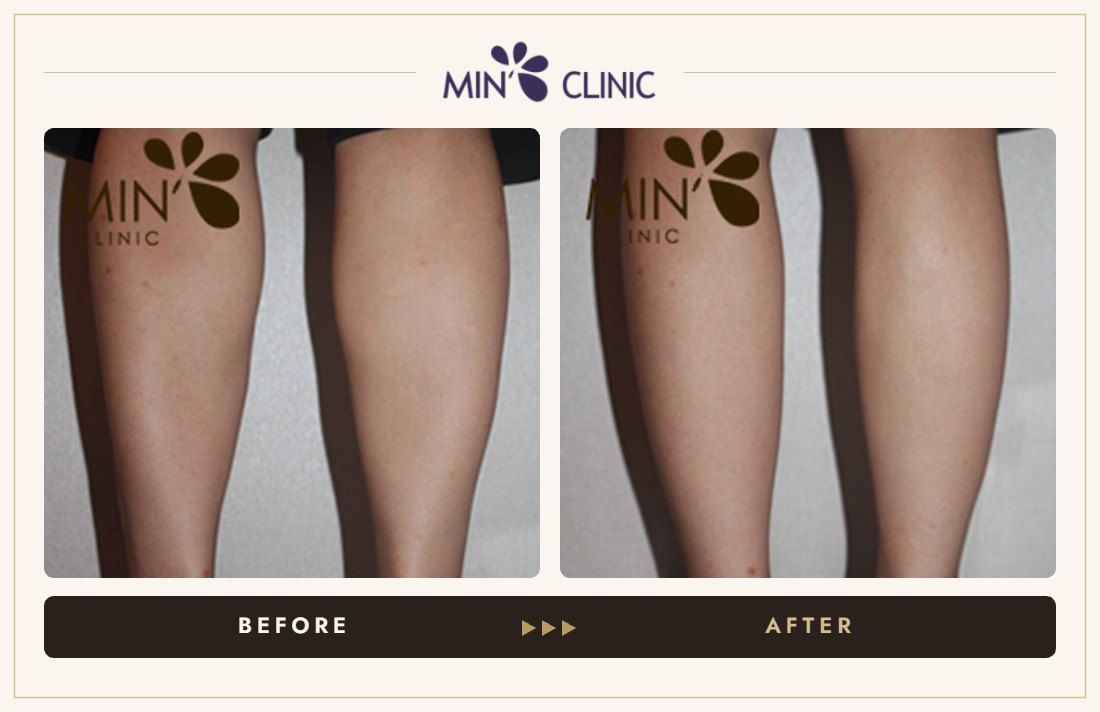 Double Skinny before and after, case 22 – MIN Clinic Seoul