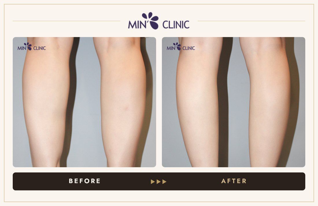 Double Skinny before and after, case 23 – MIN Clinic Seoul