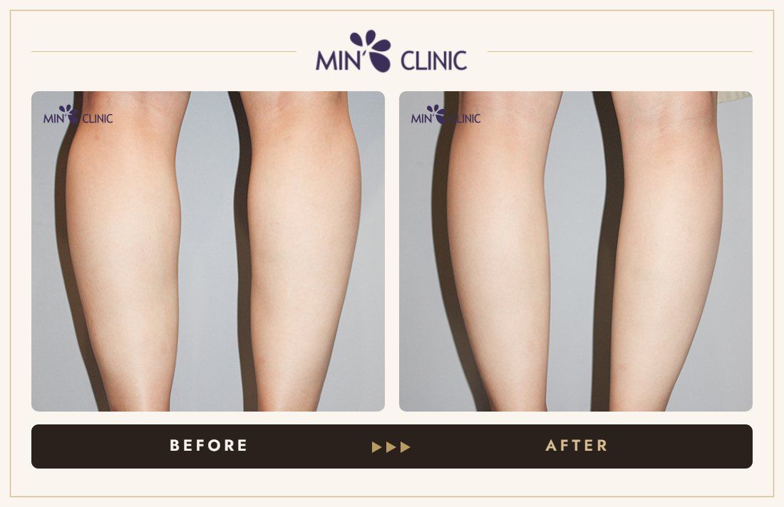 Double Skinny before and after, case 24 – MIN Clinic Seoul