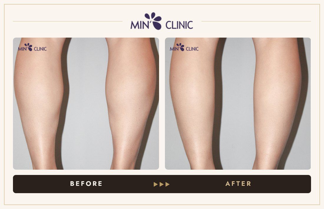 Double Skinny before and after, case 25 – MIN Clinic Seoul