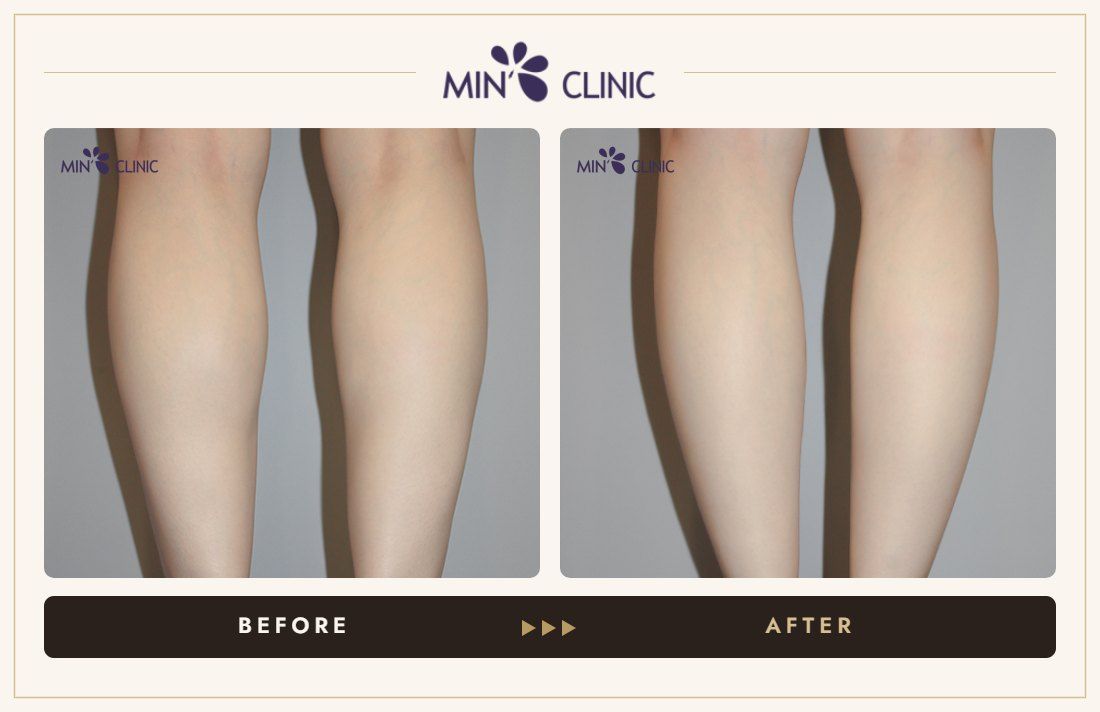 Double Skinny before and after, case 26 – MIN Clinic Seoul
