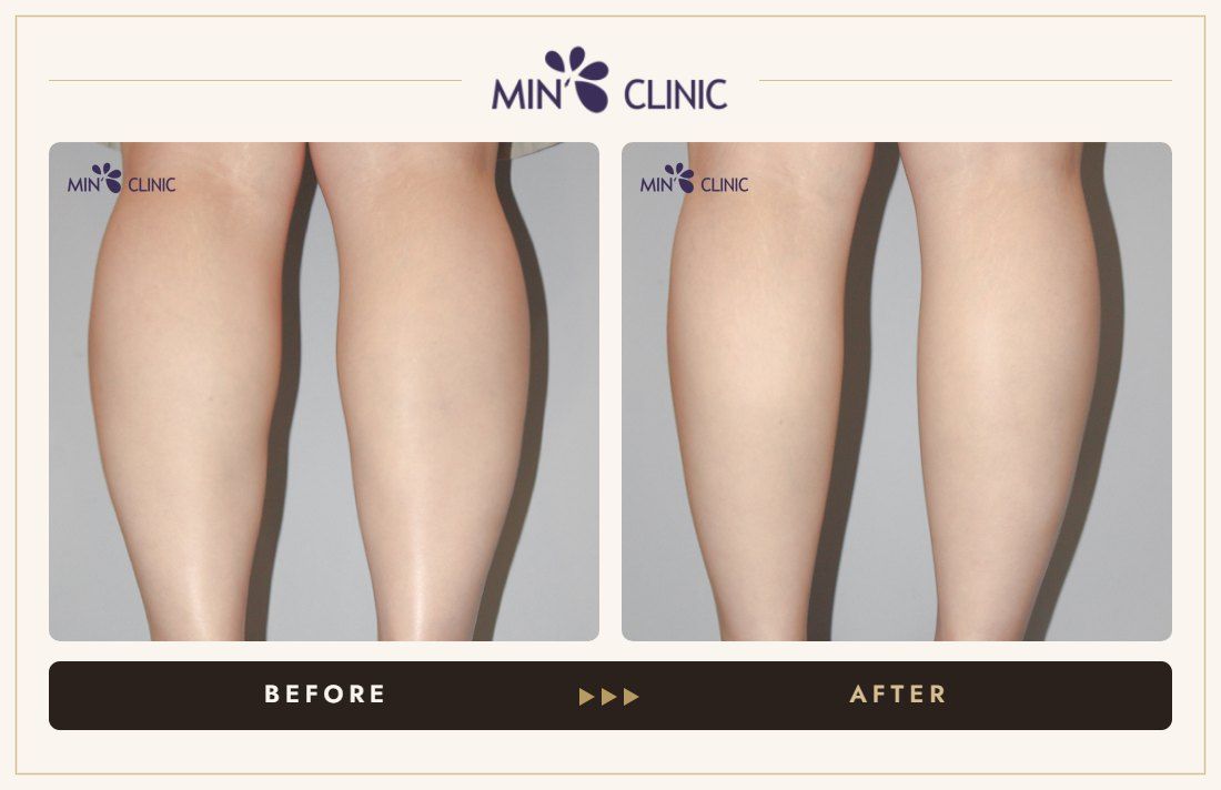 Double Skinny before and after, case 27 – MIN Clinic Seoul