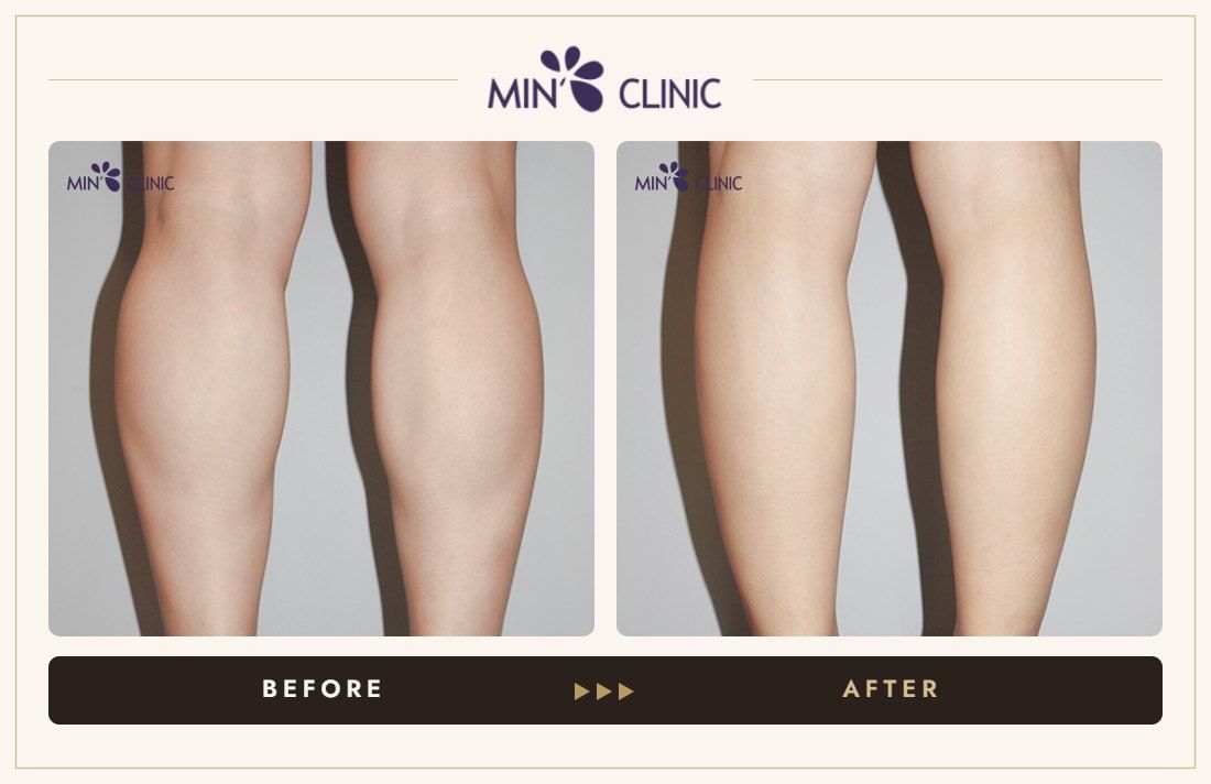 Double Skinny before and after, case 28 – MIN Clinic Seoul