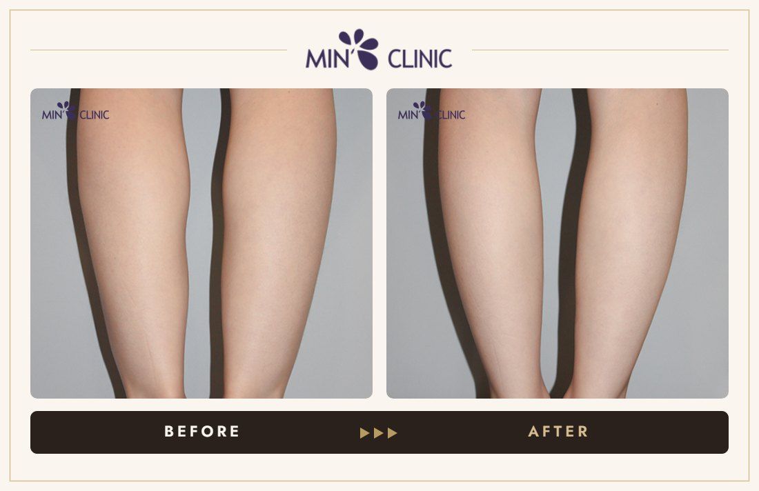 Double Skinny before and after, case 29 – MIN Clinic Seoul