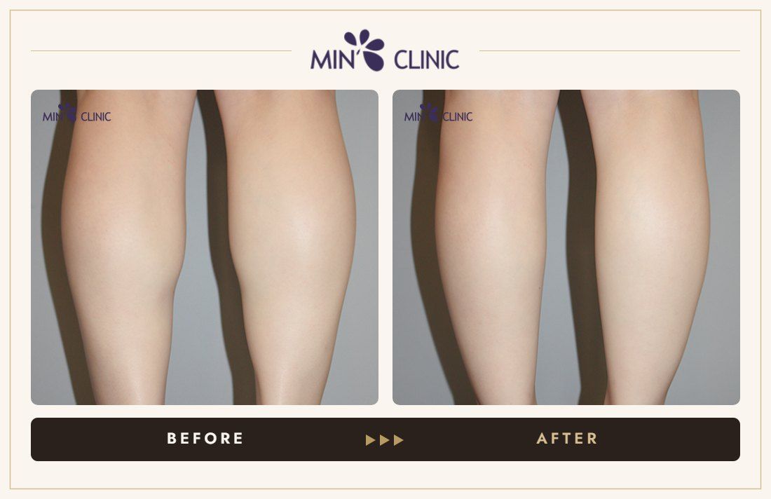 Double Skinny before and after, case 30 – MIN Clinic Seoul