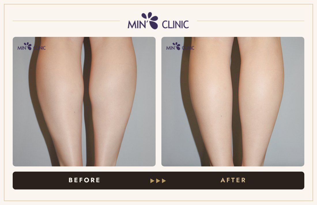 Double Skinny before and after, case 31 – MIN Clinic Seoul