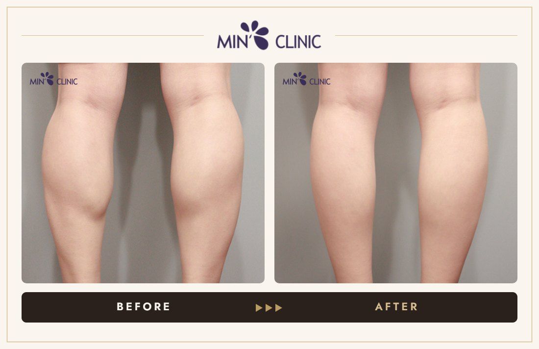 Double Skinny before and after, case 32 – MIN Clinic Seoul