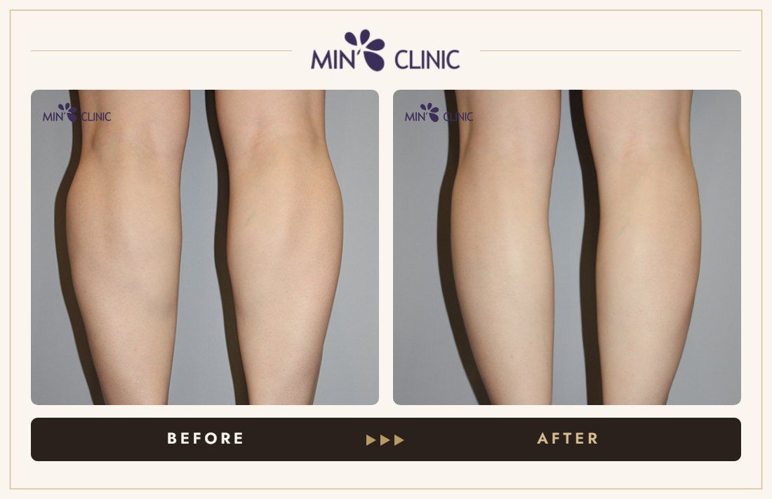 Double Skinny before and after, case 33 – MIN Clinic Seoul