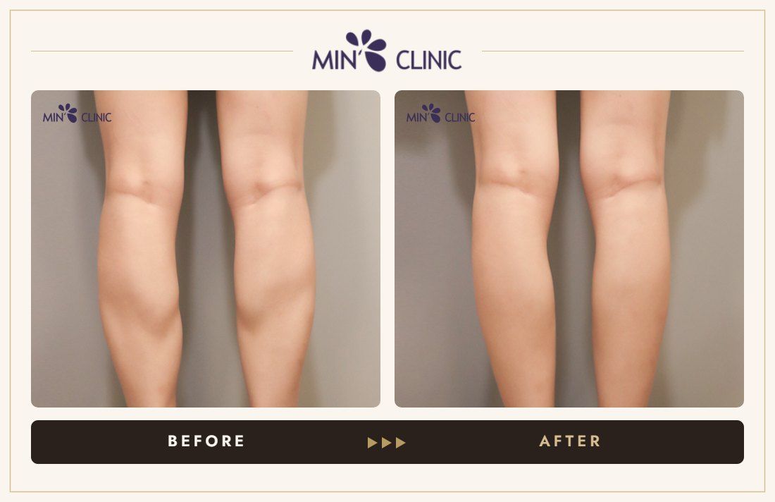 Double Skinny before and after, case 34 – MIN Clinic Seoul