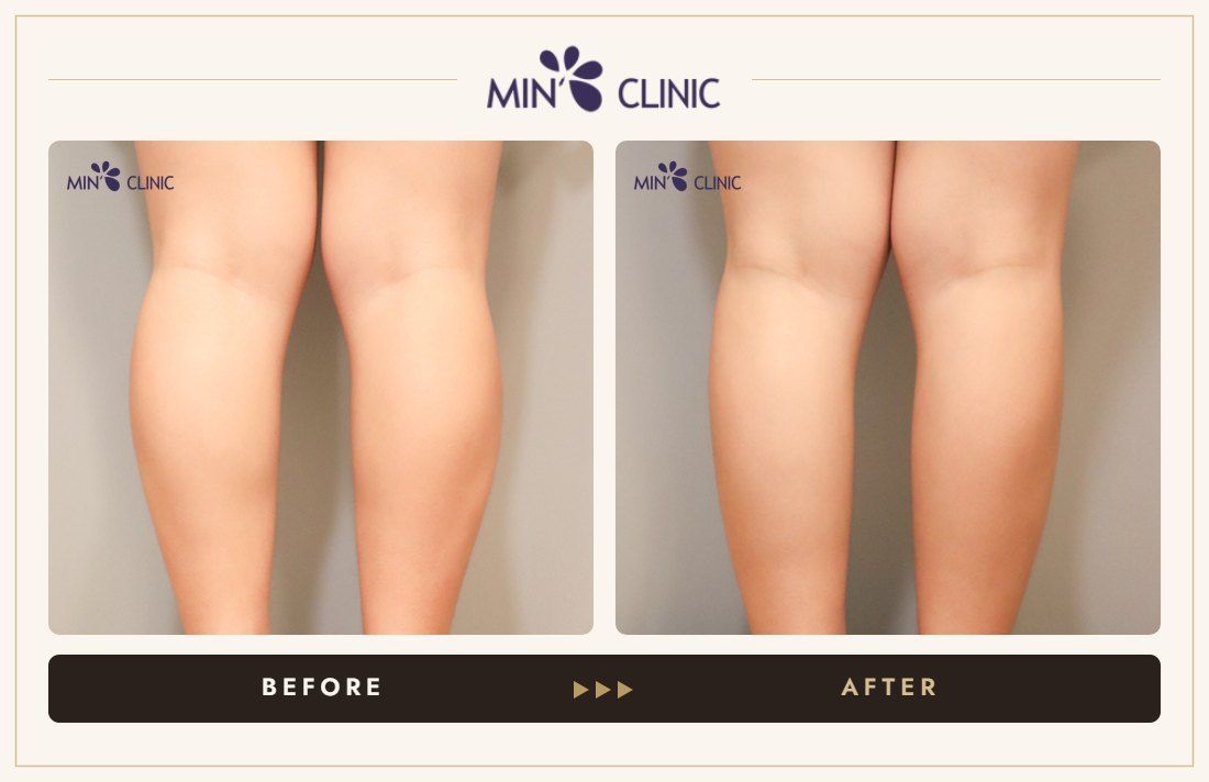 Double Skinny injection before and after – MIN Clinic Gangnam, Seoul