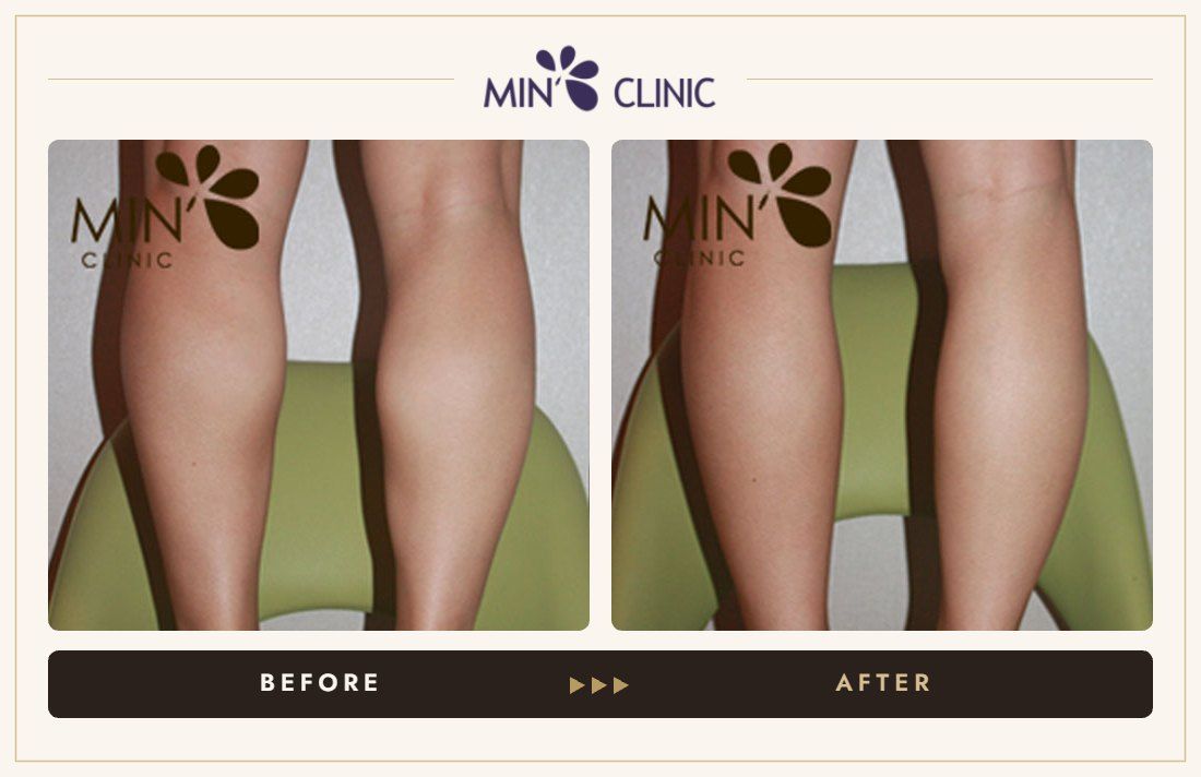 Double Skinny before and after, case 2 – MIN Clinic Seoul