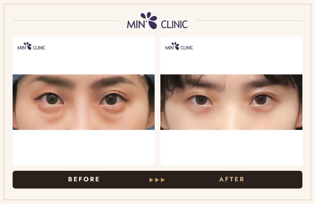 Dual Dark injection before and after, case 3 – MIN Clinic Seoul