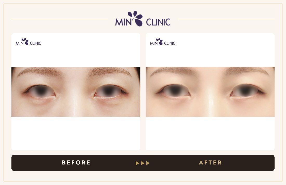 Dual Dark injection before and after, case 4 – MIN Clinic Seoul