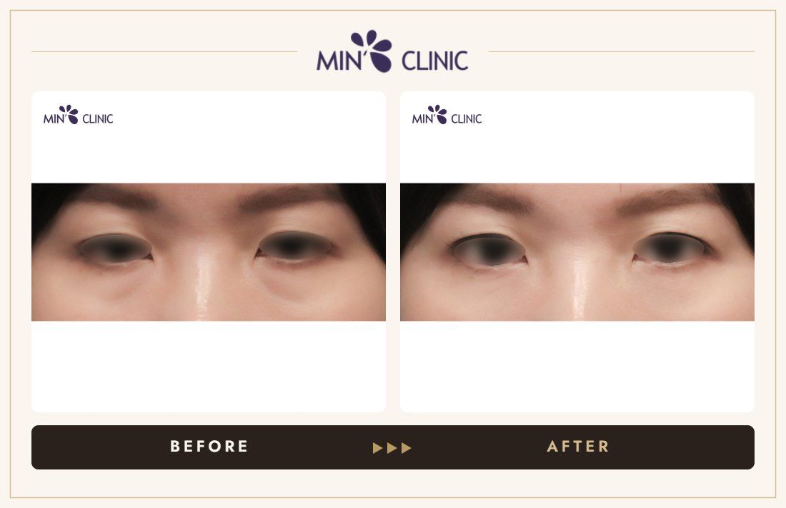 Dual Dark injection before and after, case 5 – MIN Clinic Seoul