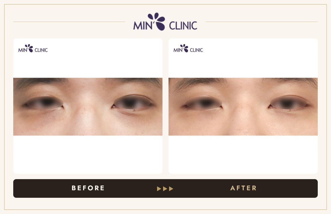 Dual Dark injection before and after, case 6 – MIN Clinic Seoul