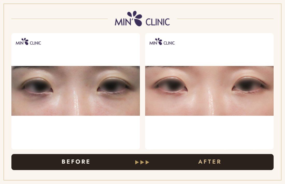 Dual Dark injection before and after, case 7 – MIN Clinic Seoul