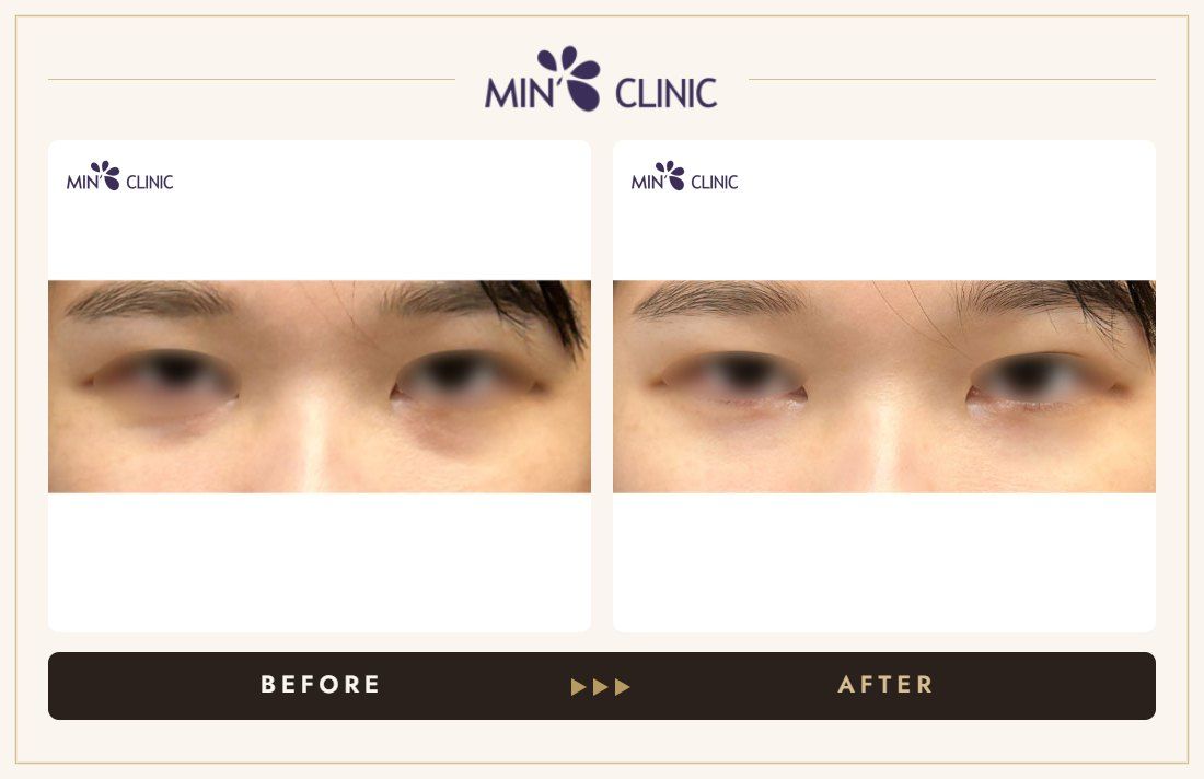 Dual Dark injection before and after, case 8 – MIN Clinic Seoul
