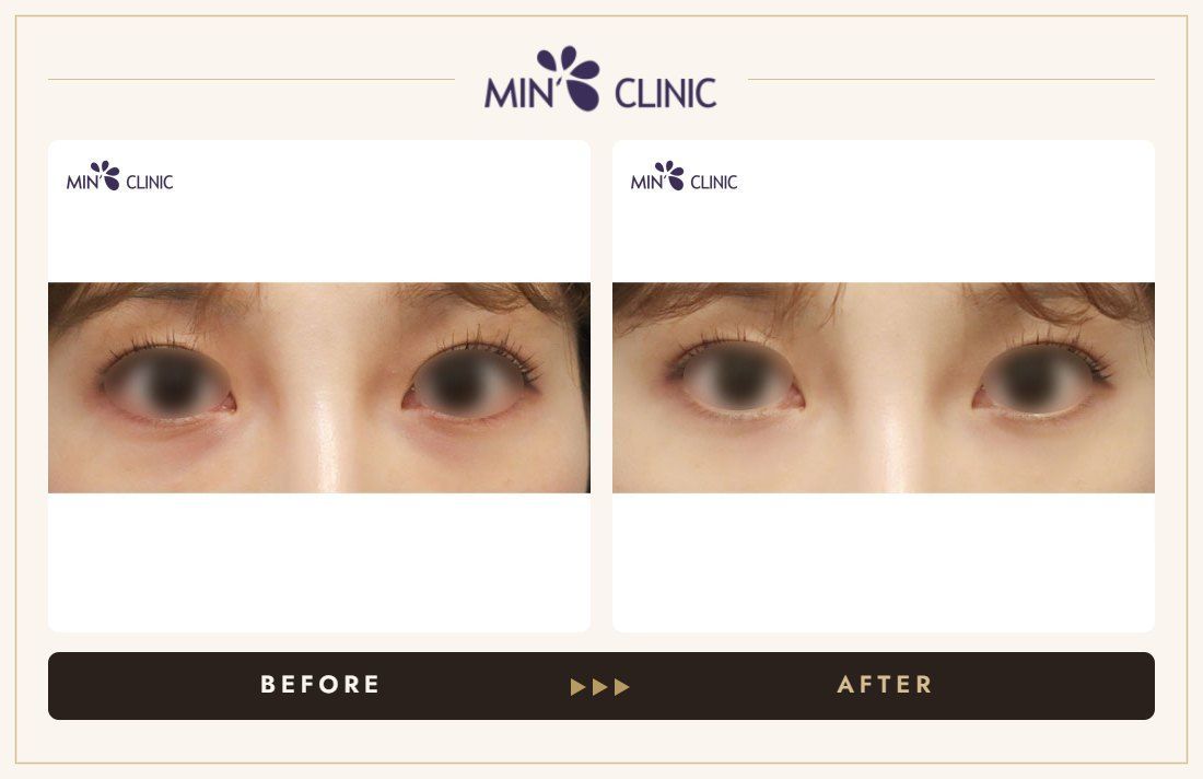 Dual Dark injection before and after, case 9 – MIN Clinic Seoul