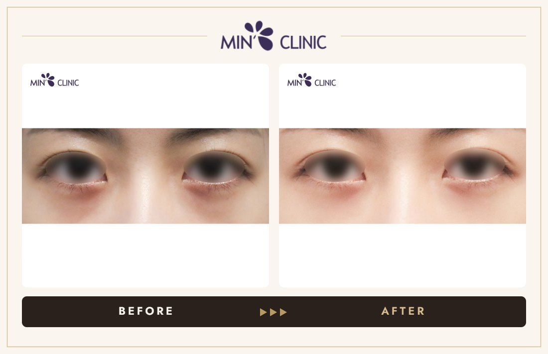 Dual Dark injection before and after, case 10 – MIN Clinic Seoul