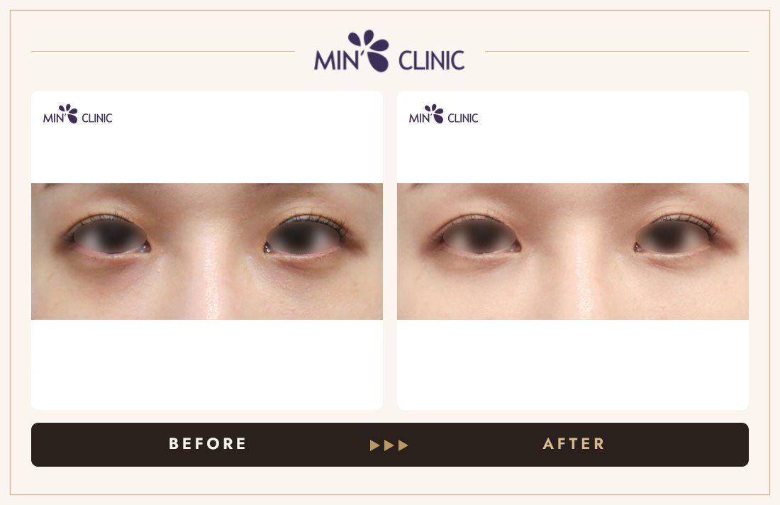 Dual Dark injection before and after, case 11 – MIN Clinic Seoul