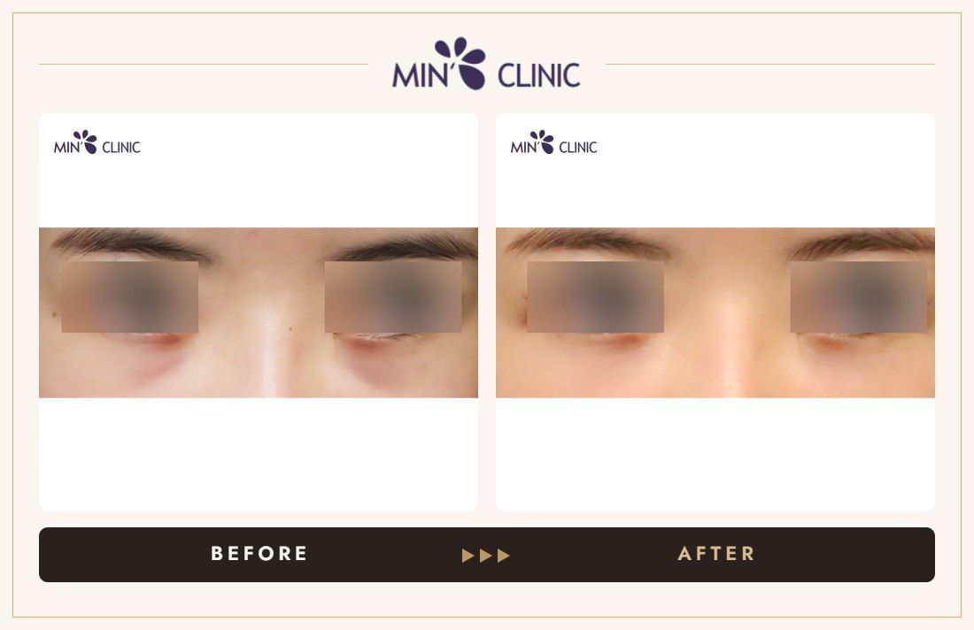 Dual Dark injection before and after, case 12 – MIN Clinic Seoul