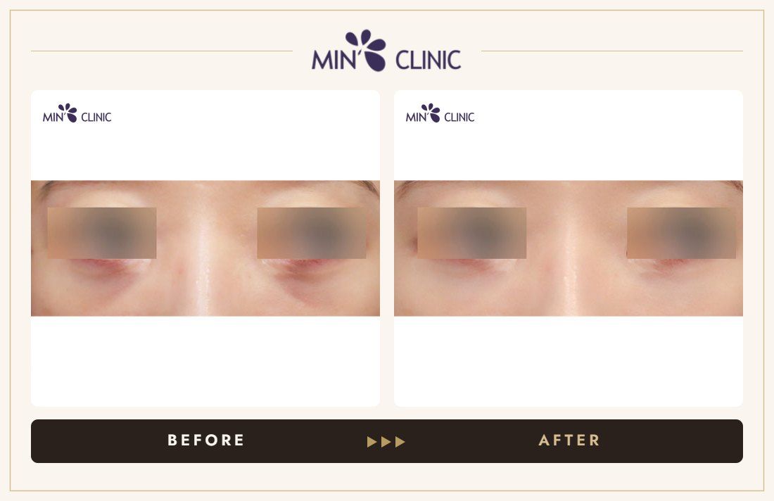 Dual Dark injection before and after, case 13 – MIN Clinic Seoul